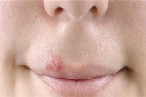 Essential Oils for Herpes Treatment: A Comprehensive Overview