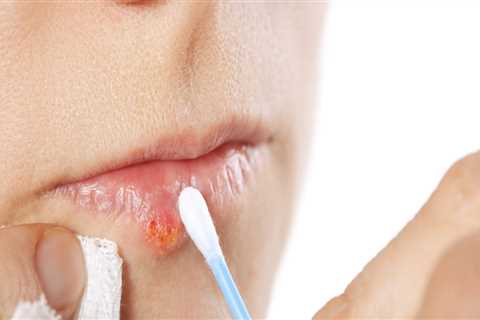 Preventing Herpes Lips Through Avoiding Contact with Infected People and Objects