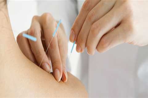 The Benefits of Acupuncture: An Alternative Therapy for Herpes Remedies