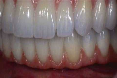 How Long Does All-on-4 Denture Last?