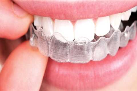 Can You Get Invisalign Clear Braces Without Taking Impressions?