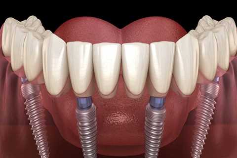 Are All-on-Four Dentures Comfortable and Reliable?