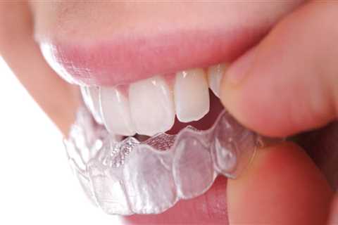 Invisalign In Austin: A Comprehensive Guide To The Clear Aligner Treatment