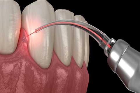 Do you need anesthesia for laser dentistry?