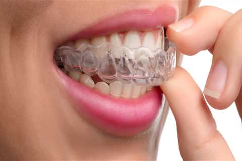 Straighten Your Teeth Discreetly With Invisalign: A Guide To Finding The Right Dentist In Woden