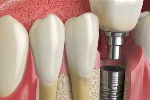 How long does a dental implant last?