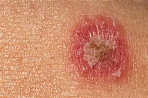 Ringworm: Everything You Need to Know