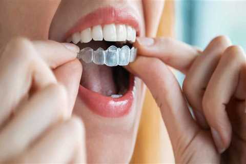 What are Spark Clear Aligners and How Can They Help You?