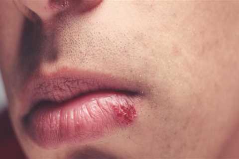 Aromatherapy for Treating Herpes Lips: An Overview