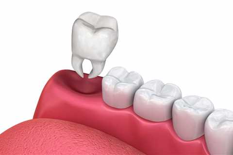 The Basic Principles Of Tooth Extractions