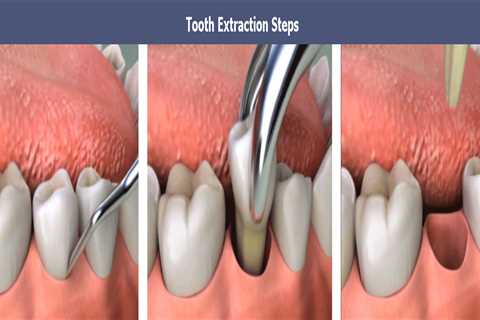 The Basic Principles Of Tooth Extractions