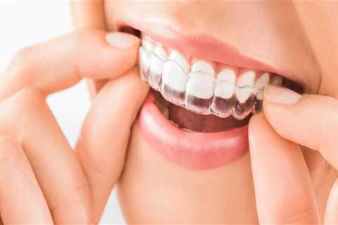 Straighten Your Teeth With Invisalign Clear Braces In Austin