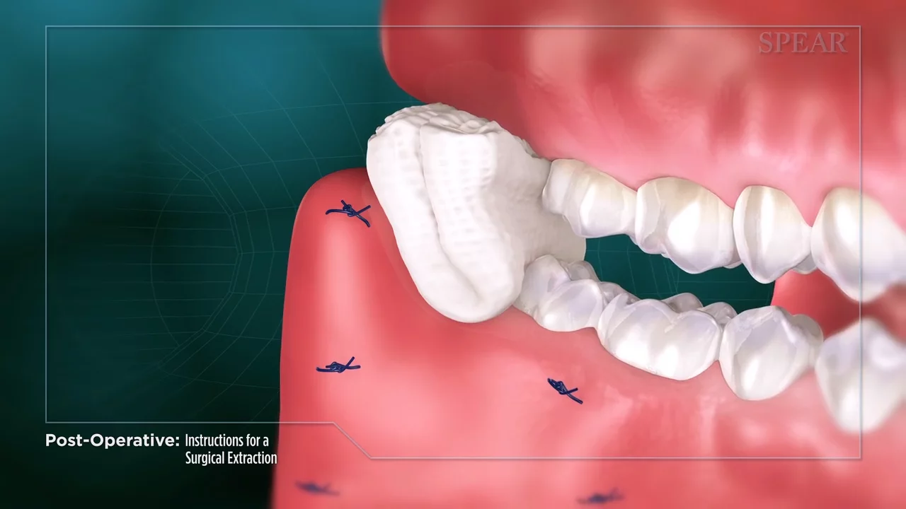 7 Easy Facts About Tooth Extractions Described