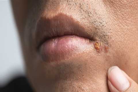 Understand the Risk Factors for HSV-1 and HSV-2