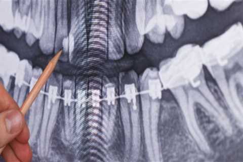 What is the difference between panoramic x-rays and full mouth x-rays?