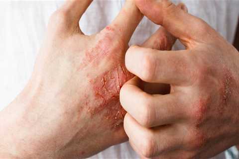 Eczema Treatments: A Comprehensive Overview