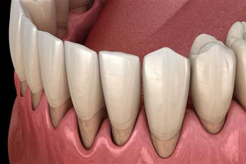 Can Dentures Be Fitted to Receding Gums? A Comprehensive Guide