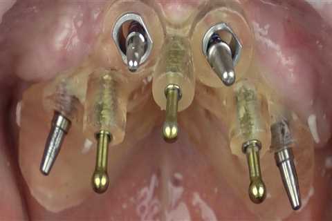 Types of Dental Procedures: A Comprehensive Guide