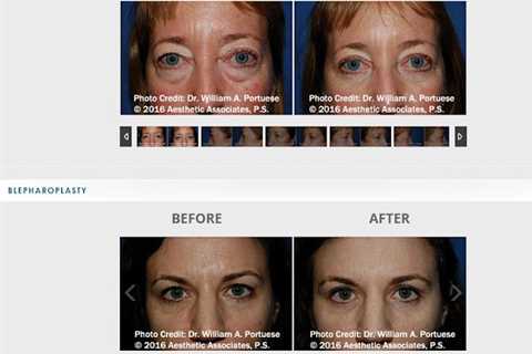 The Seattle Eyelid & Blepharoplasty Center