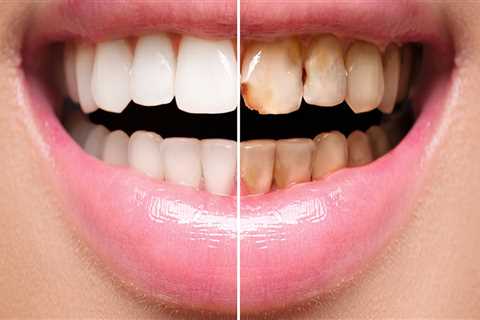 Top 7 Benefits Of Dental Veneers You Need To Know In Austin, TX