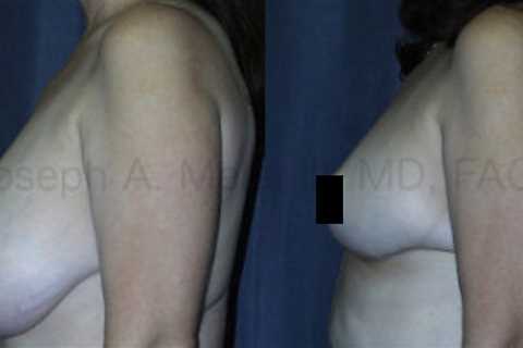 Breast Reduction Surgery for Women