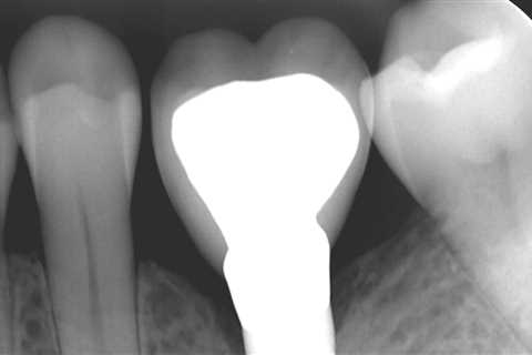 What is the gap between implant crown and tooth?