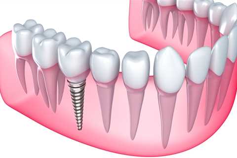 Can I Get a Dental Implant After a Tooth Extraction?
