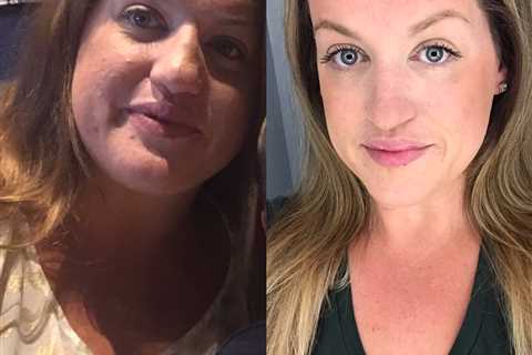Olivia’s Victory Over Hashimoto’s and PCOS: A Carnivore Diet Success Story from Toronto