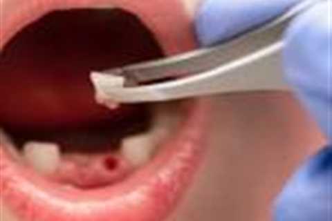 Tooth extraction patients