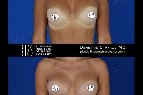 Standard post published to Dr. Demetris Stavrou - European Institute of Plastic Surgery - Nicosia..