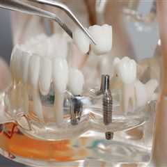 Dentist Tips And Tricks For Maintaining Your Dental Implants In Canberra