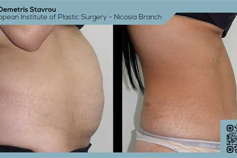 Standard post published to Dr. Demetris Stavrou - European Institute of Plastic Surgery - Nicosia..