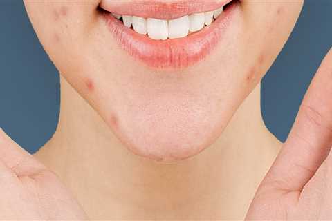 Understanding the Causes of Acne
