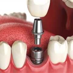 Which is the best type of dental implants?