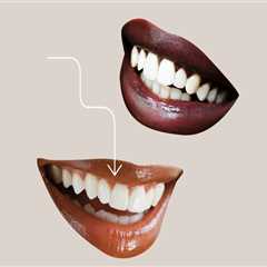 Exploring The Different Types Of Dental Veneer Procedures Available In Mansfield