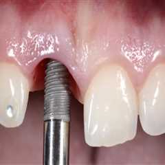 Discovering The Benefits Of Dental Implants In Austin