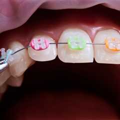 What Are the Best Colors for Braces?
