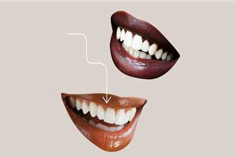 Exploring The Different Types Of Dental Veneer Procedures Available In Mansfield