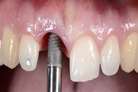 Discovering The Benefits Of Dental Implants In Austin