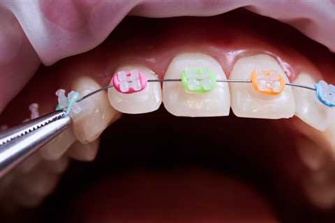 What Are the Best Colors for Braces?