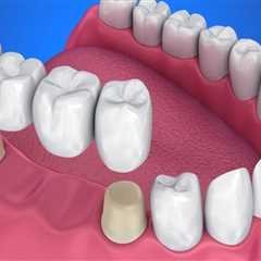 Maintenance for Dental Bridges: Keeping Your Smile and Wallet Healthy