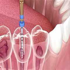 Understanding the Procedure for a Root Canal