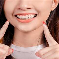 How Long to Wear Retainer After Braces