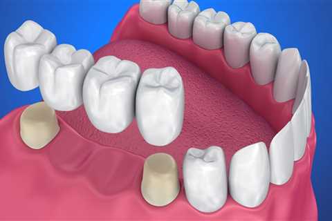 Maintenance for Dental Bridges: Keeping Your Smile and Wallet Healthy