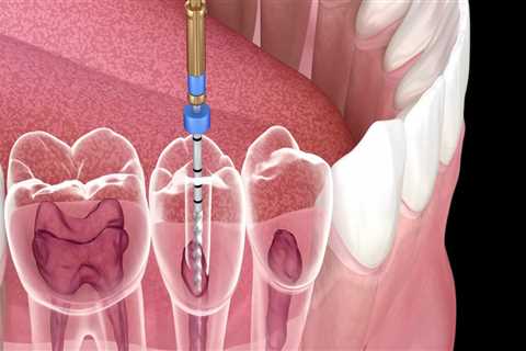 Understanding the Procedure for a Root Canal