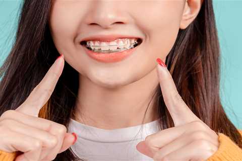 How Long to Wear Retainer After Braces