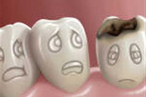 Understanding Tooth Decay: Prevention, Symptoms, and Treatment