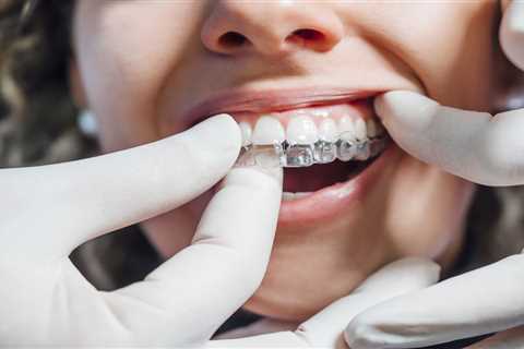 How to Prevent Clear Braces From Staining