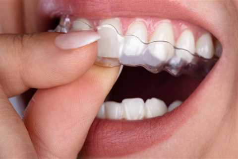 When to Wear Clear Aligners