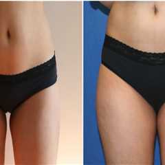 How Cosmetic Liposuction In Chevy Chase, Maryland Can Support Personal Development And Improve..